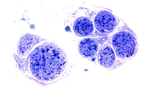 13A1 Axonal Degeneration, fulminant (Case 13) Plastic 6