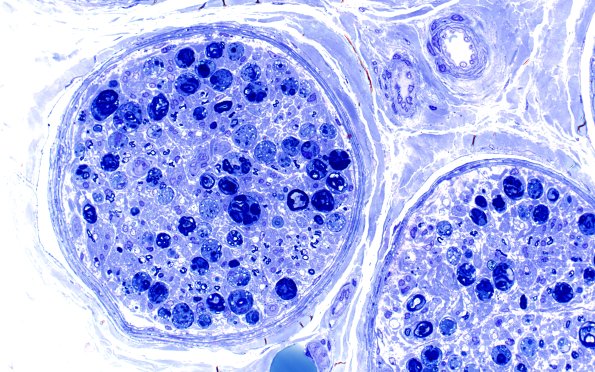 13A2 Axonal Degeneration, fulminant (Case 13) Plastic 7