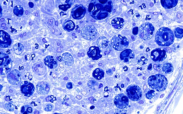 13A3 Axonal Degeneration, fulminant (Case 13) Plastic 16