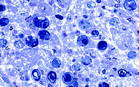 13A4 Axonal Degeneration, fulminant (Case 13) Plastic 17
