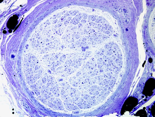 14A1 Axonal degeneration (end-stage nerve, Case 14) Plastic 4