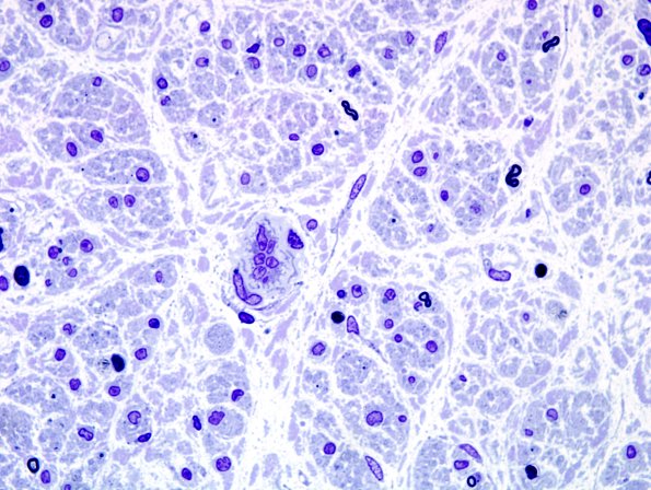 14A2 Axonal degeneration (end-stage nerve, Case 14) Plastic 1