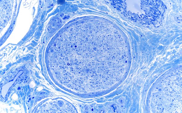 15A1 End Stage Nerve (Case 15) Plastic 20X 1