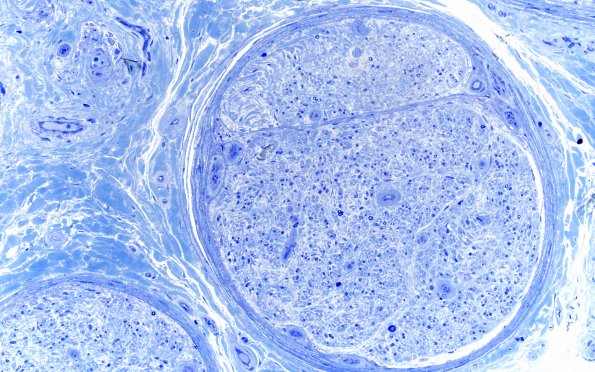 15A2 End Stage Nerve (Case 15) Plastic 20X 3