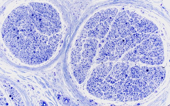 17A1 Loss Large Fibers (Case 17) Plastic 1