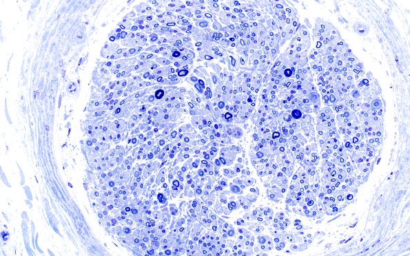 17A2 Loss Large Fibers (Case 17) Plastic 2