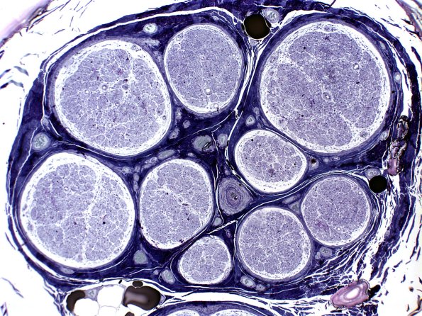 18A End stage nerve (Case 18) Plastic 1