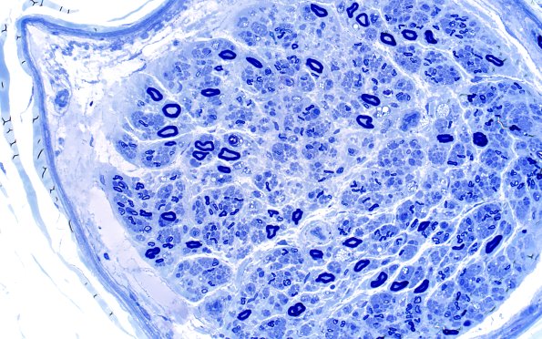 19A1 Lipid xs nerve  (Case 19) 40X 2