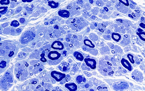 19A2 Lipid xs nerve  (Case 19) 100X 2