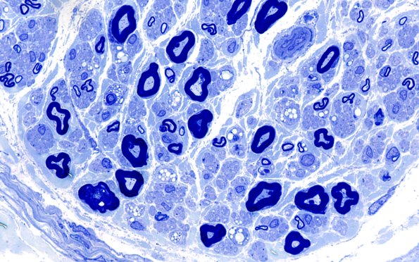 19A3 Lipid xs nerve  (Case 19) 100X 4