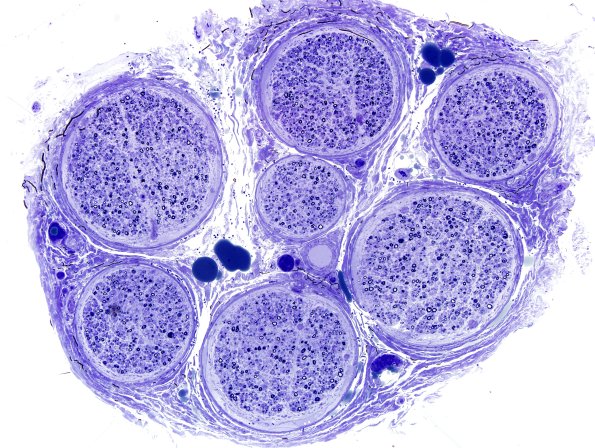 1A1 Axonal Degeneration (Case 1) Plastic 10X