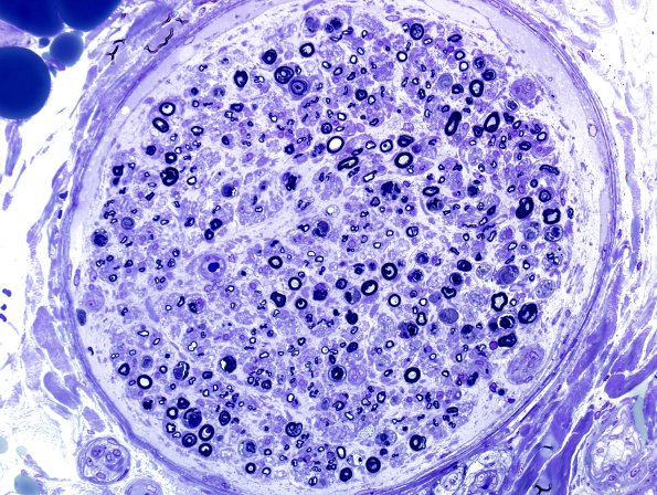 1A2 Axonal Degeneration (Case 1) Plastic 40X 3.jpg