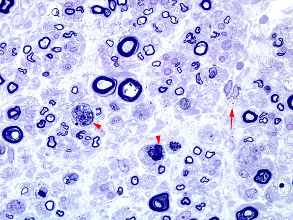 1A3 Axonal Degeneration (Case 1) Plastic 100X 1 copy.jpg