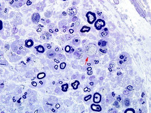 1A4 Axonal Degeneration (Case 1) Plastic 100X 3 copy.jpg