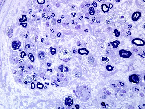 1A5 Axonal Degeneration (Case 1) Plastic 100X 5.jpg