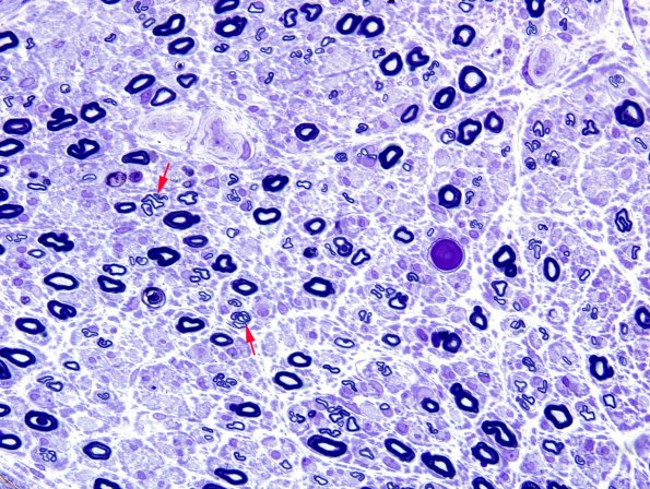 20A1 Fiber loss, small exaggerated (Case 20) Plastic 5 copy