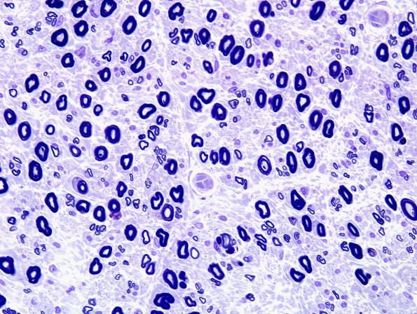 20A2 Fiber loss, small exaggerated (Case 20) Plastic 3