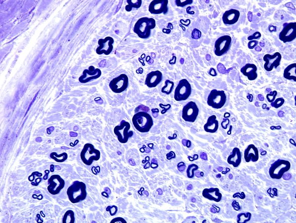 20A3 Fiber loss, small exaggerated (Case 20) Plastic 9 (best)