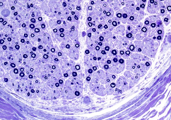 21A2 Small MF loss (Case 21) Plastic 2.jpg