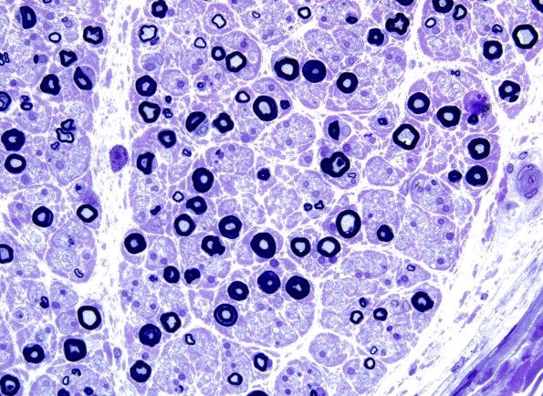 21A3 Small MF loss (Case 21) Plastic 3.jpg