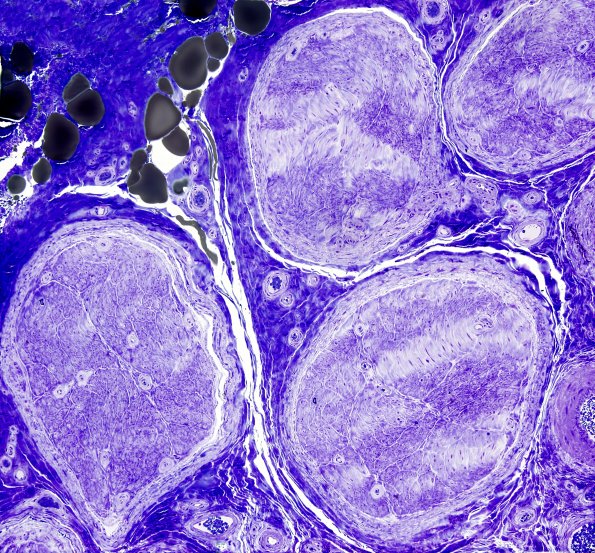 22A1 End Stage Nerve (Case 22) Plastic 3