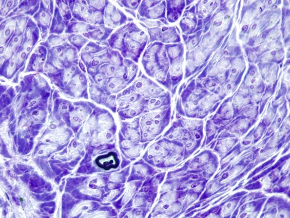 22A2 End Stage Nerve (Case 22) Plastic 7