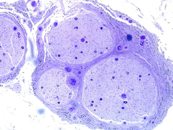 23A1 End-stage nerve (Case 23) Plastic 6.jpg