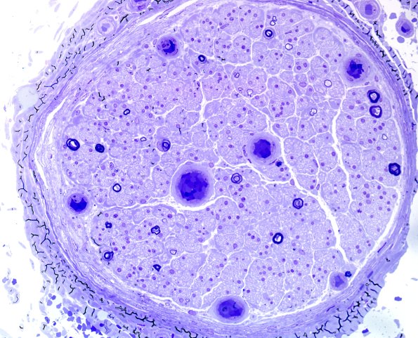 23A2 End-stage nerve (Case 23) Plastic 1.jpg