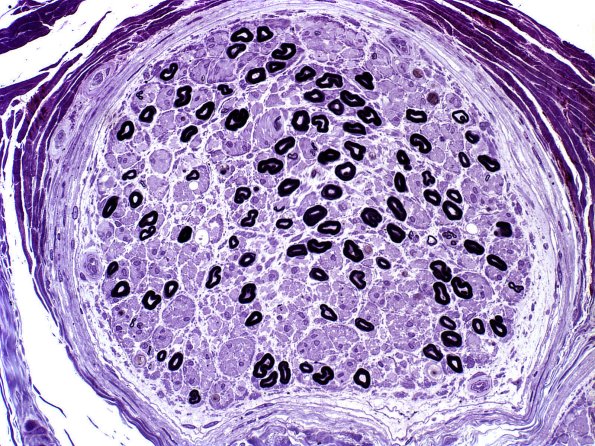 24A1 Axon loss, mostly small MF (Case 24) Plastic 1