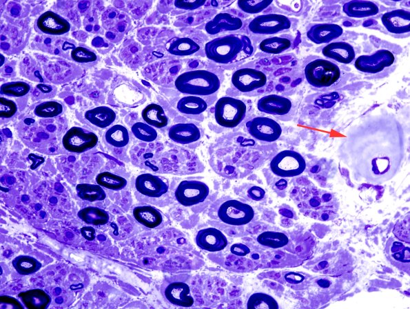 24A2 Small MF (Case 24) Amyloid Plastic 1 copy