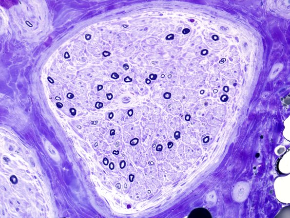 25A1 Axon loss, SMF pref loss (Case 25) Plastic 3