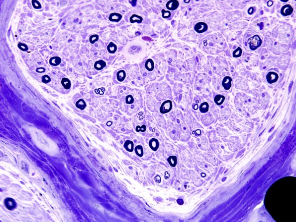 25A2 Axon loss, SMF pref loss (Case 25) Plastic 4