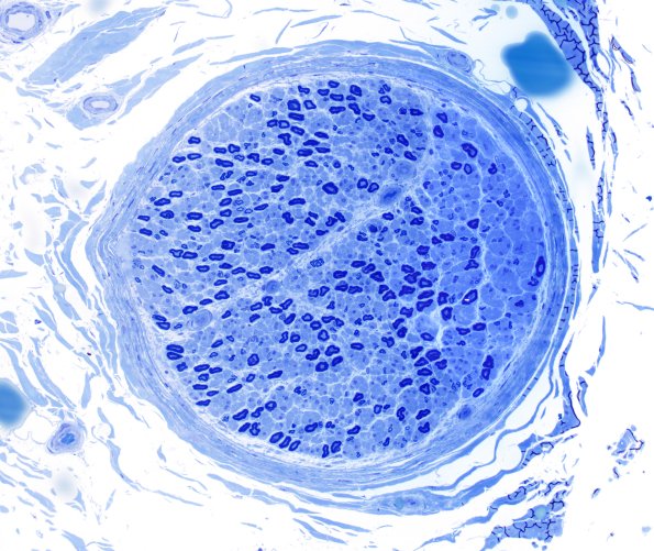 26A1 Axonal Loss (small more than large) (Case 26) Plastic 10