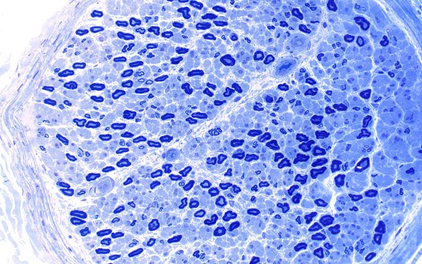 26A2 Axonal Loss (small more than large) (Case 26) Plastic 2