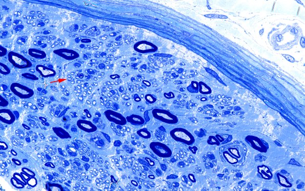 27A1 Unmyelinated axons (Case 27) Plastic 100X 1 copy B