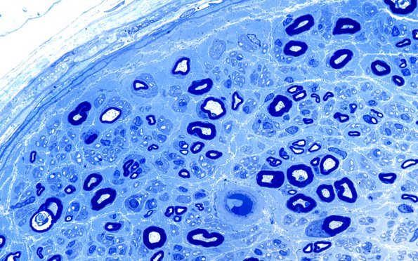 27A2 Unmyelinated axons (Case 27) Plastic 100X 2