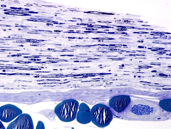 2A1 Axonal Degeneration (Case 2) Plastic 1