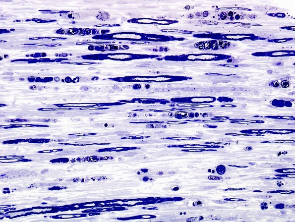 2A2 Axonal Degeneration (Case 2) Plastic 2