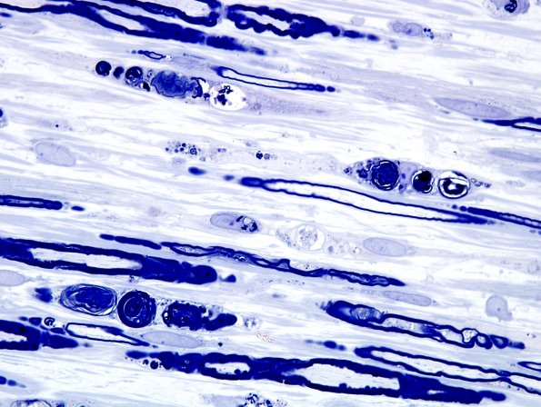 2A3 Axonal Degeneration (Case 2) Plastic 6