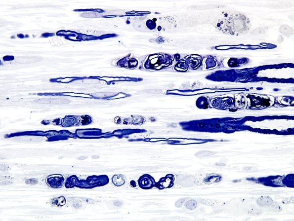 2A4 Axonal Degeneration (Case 2) Plastic 4
