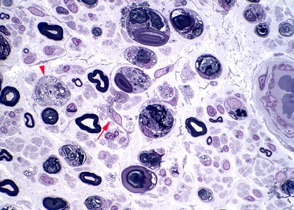 3A1 Axonal Degeneration (Case 3) Plastic 2 copy