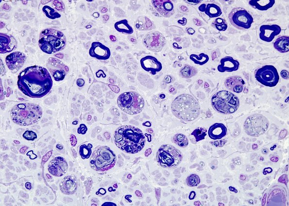 3A2 Axonal Degeneration (Case 3) sharpen Plastic 1