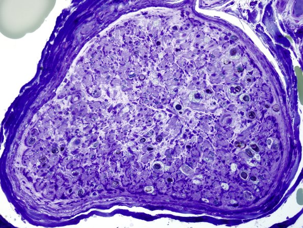 4A1 Axonal Degeneration (Case 4) Plastic 5