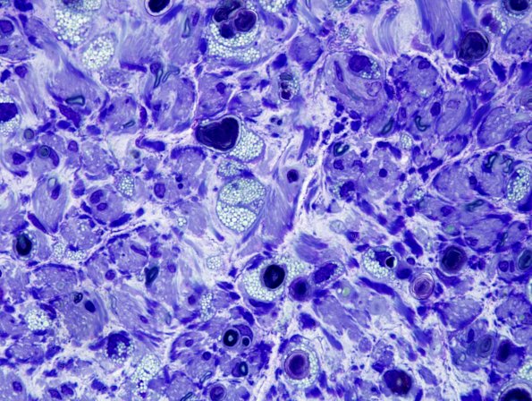 4A2 Axonal Degeneration (Case 4) Plastic 4