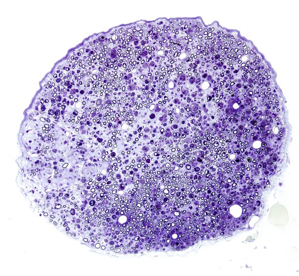 5A1 Axonal Degeneration (Case 5) Plastic 7