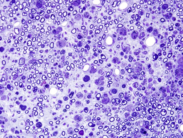 5A3 Axonal Degeneration (Case 5) Plastic 5