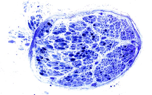7A1 Axonal Degeneration (Case 7) Plastic 3
