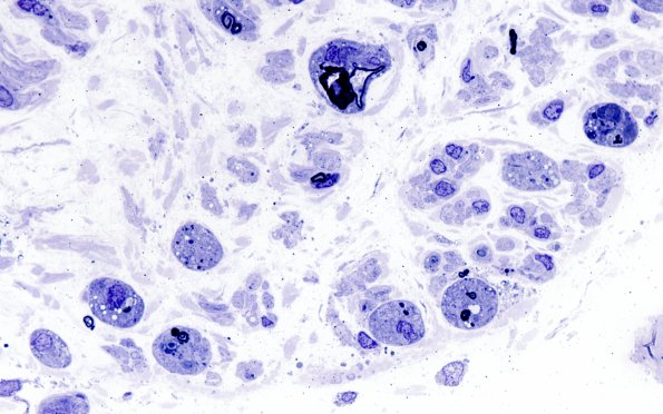 7A2 Axonal Degeneration (Case 7) Plastic 2