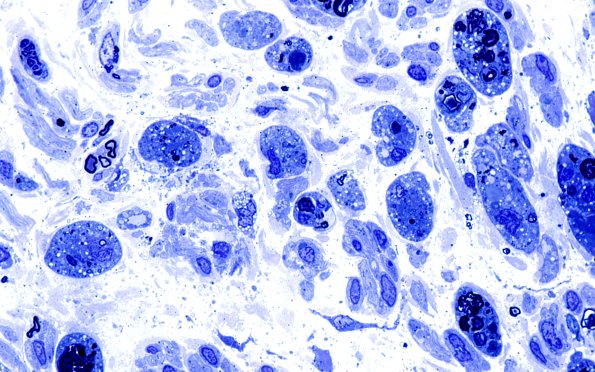 7A3 Axonal Degeneration (Case 7) Plastic 7