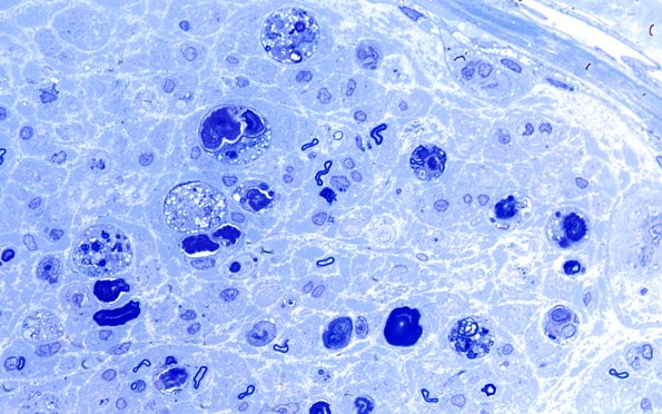 8A1 Axonal degeneration (Case 8) Plastic 100X 1
